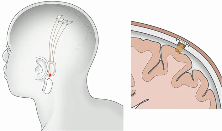 Neuralink Implant